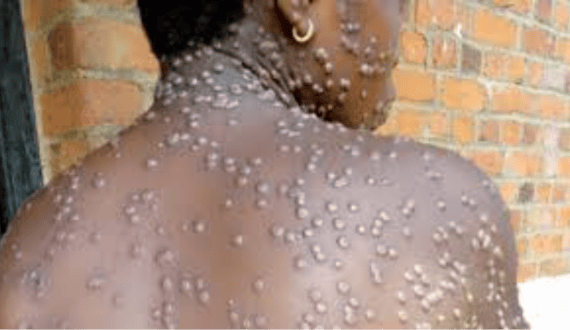Thumbnail for Chile becomes first country in the Americas to eliminate leprosy, WHO confirms