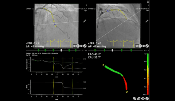 Thumbnail for Siemens-backed Study proves software-guided heart assessments are as effective as invasive wires