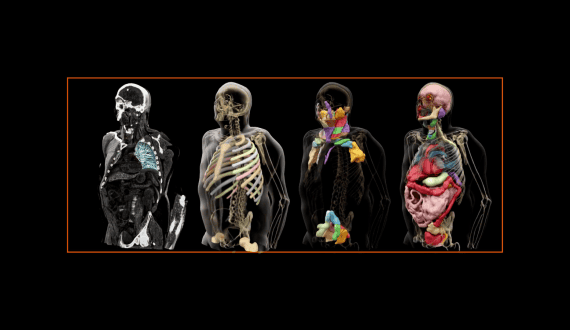 Thumbnail for Siemens Healthineers’ Varian secures CE mark for AI-powered radiation therapy planning tool