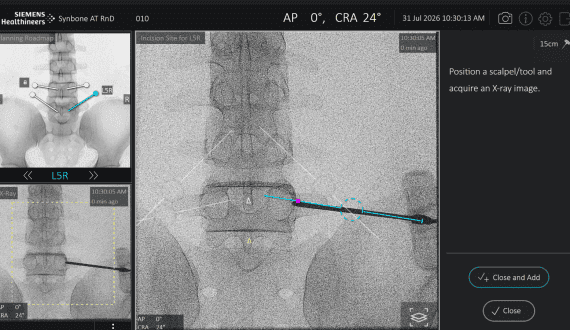 Thumbnail for JOOTRH completes historic first VNS epilepsy surgery in East Africa