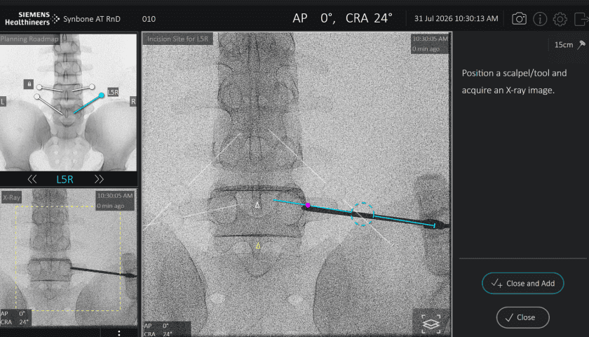 Thumbnail for Siemens Healthineers integrates trackerless spinal guidance software into Cios Spin